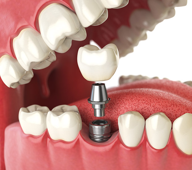 Nacogdoches Will I Need a Bone Graft for Dental Implants