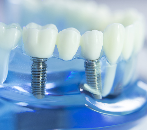 Nacogdoches Dental Implants