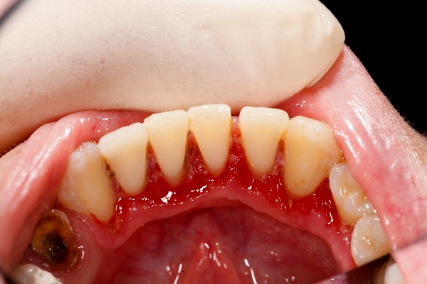 Can Periodontal Disease Be Reversed?